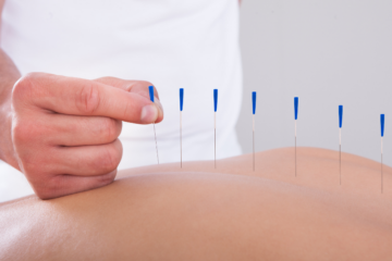 Dry Needling/Acupuncture